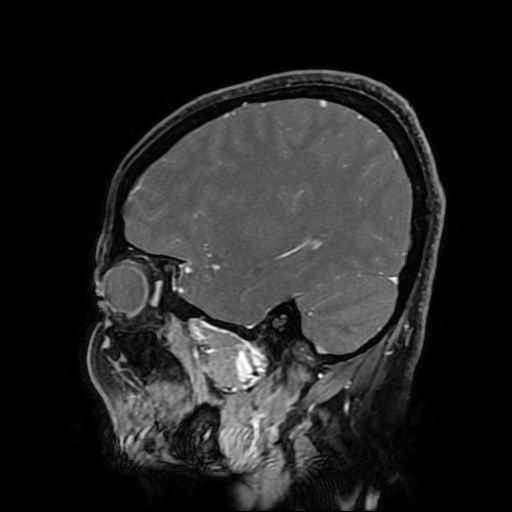 Chordoid glioma of third ventricle (Radiopaedia 91612-109340 F 151).jpg