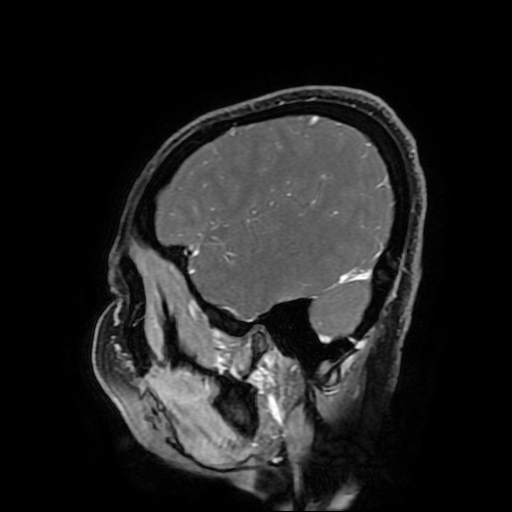 File:Chordoid glioma of third ventricle (Radiopaedia 91612-109340 F 166).jpg