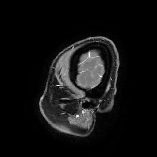 Chordoid glioma of third ventricle (Radiopaedia 91612-109340 F 189).jpg
