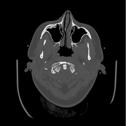 Choroid plexus papilloma extending into the cerebellopontine angle cistern (Radiopaedia 85941-101833 Axial bone window 14).png