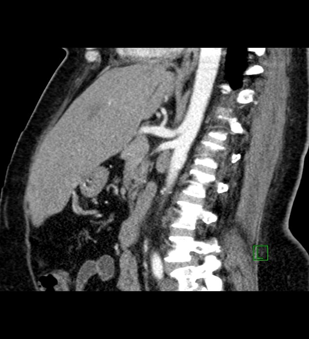 Chromophobe renal cell carcinoma (Radiopaedia 84239-99519 D 58).jpg