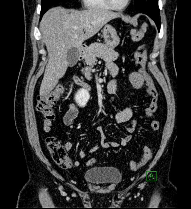 Chromophobe renal cell carcinoma (Radiopaedia 84286-99573 H 63).jpg
