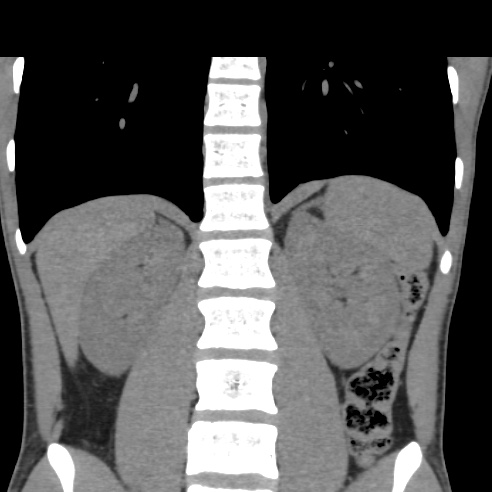File:Chronic calcific pancreatitis (Radiopaedia 56280-62953 Coronal non-contrast 25).jpg