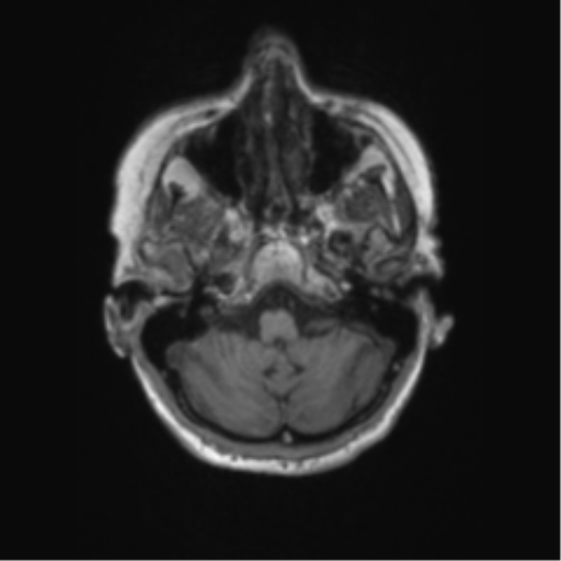 Chronic hypertensive encephalopathy (Radiopaedia 72844-83495 Axial T1 60).png