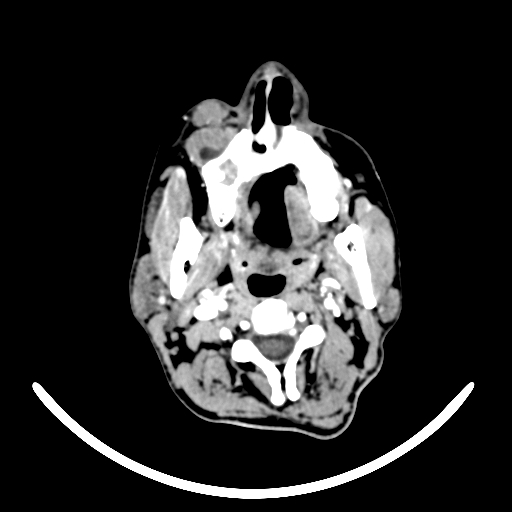 Chronic invasive fungal sinusitis with intraorbital and intracranial extension (Radiopaedia 56387-63046 B 2).jpg
