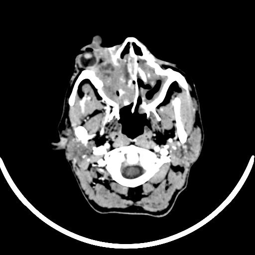 Chronic invasive fungal sinusitis with intraorbital and intracranial extension (Radiopaedia 56387-63046 B 46).jpg