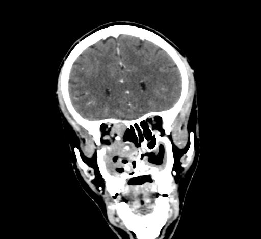 Chronic invasive fungal sinusitis with intraorbital and intracranial extension (Radiopaedia 56387-63046 C 122).jpg