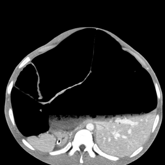 Chronic large bowel pseudo-obstruction (Radiopaedia 43181-46492 A 56).jpg