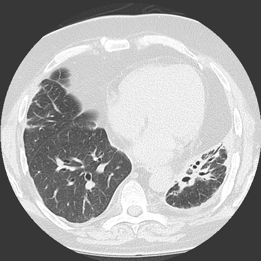Chronic lung allograft dysfunction - restrictive form (Radiopaedia 60595-68316 Axial lung window 46).jpg