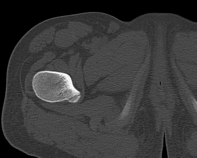 Chronic ostemyelitis of the femur with long sinus tract (Radiopaedia 74947-85982 Axial bone window 20).jpg