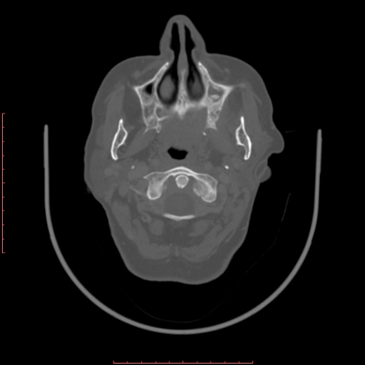 Chronic osteomyelitis - maxilla (Radiopaedia 23783-23927 Axial bone window 90).jpg