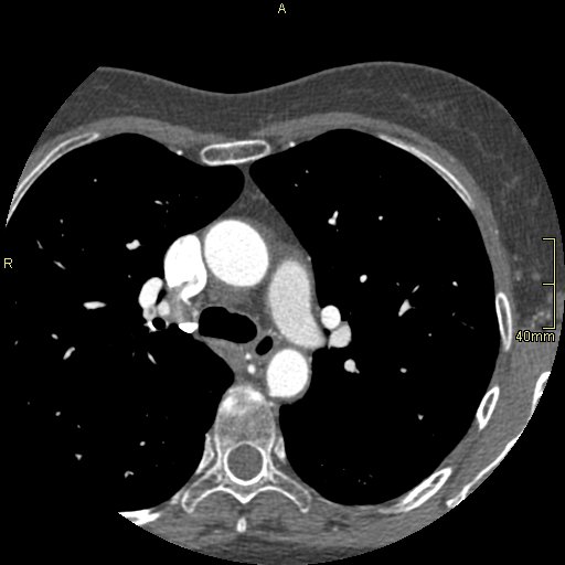 Chronic pulmonary embolism (Radiopaedia 73073-85094 Axial C+ CTPA 38).jpg