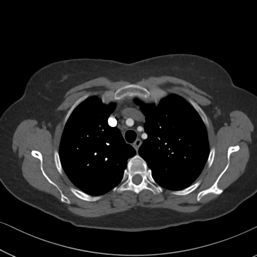 Chronic pulmonary embolus (Radiopaedia 39129-41341 Axial C+ CTPA 27).png