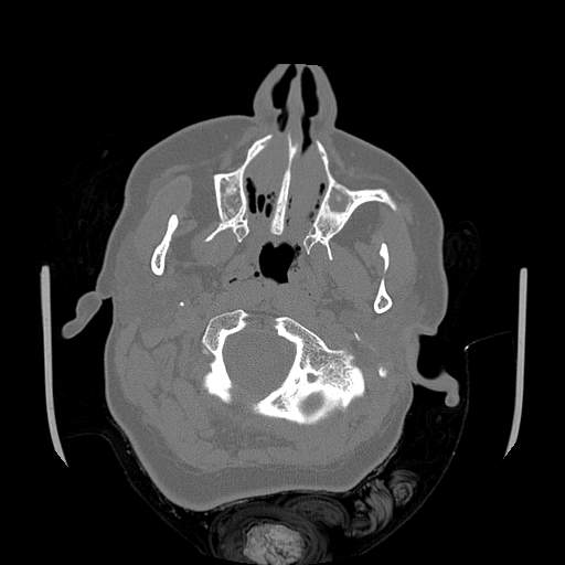 Chronic sinusitis with intra-sinus calcification (Radiopaedia 63919-72668 Axial bone window 72).jpg