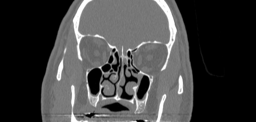 Chronic sphenoidal sinusitis (Radiopaedia 62030-70122 Coronal bone window 65).jpg