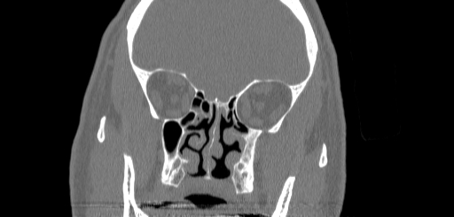 Chronic sphenoidal sinusitis (Radiopaedia 62030-70122 Coronal bone window 77).jpg