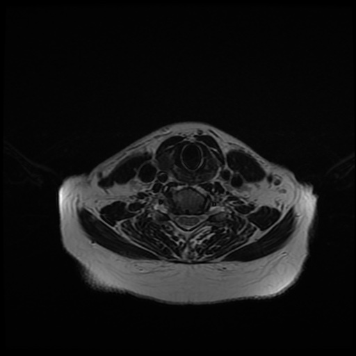 File:Chronic submandibular sialadenitis (Radiopaedia 61852-69885 Axial T2 23).jpg