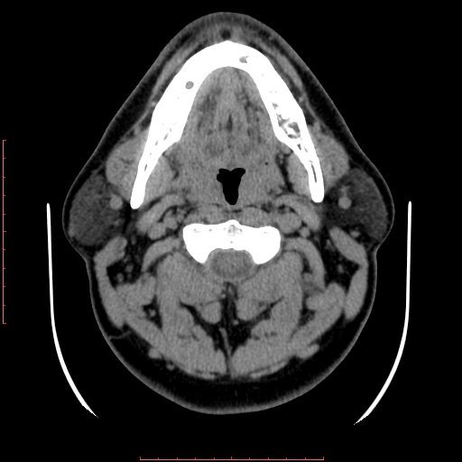 Chronic submandibular sialolithiasis (Radiopaedia 69817-79814 Axial non-contrast 87).jpg