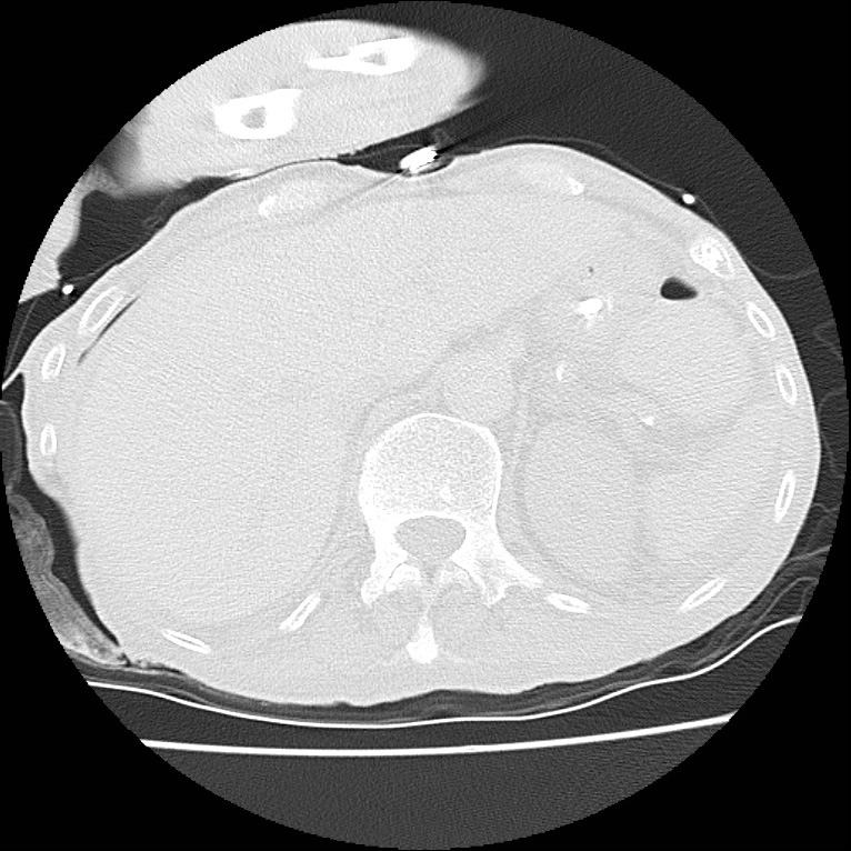 Clagett thoracotomy with bronchopleural fistula (Radiopaedia 29192-29587 Axial lung window 51).jpg