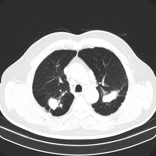 Classic complicated silicosis (Radiopaedia 49720-54961 Axial lung window 17).jpg