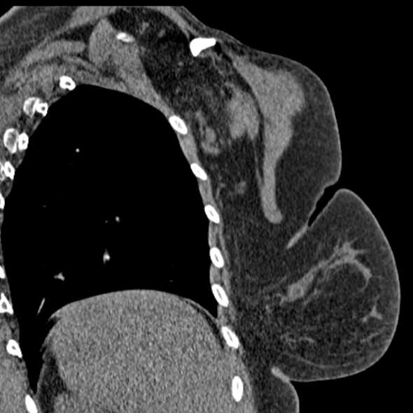Clear cell chondrosarcoma - humerus (Radiopaedia 63104-71612 Coronal non-contrast 47).jpg