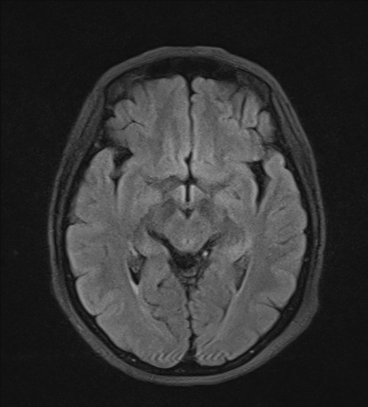 File:Clival meningioma (Radiopaedia 53278-59248 Axial FLAIR 11).jpg