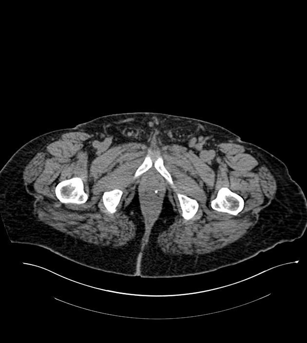 Closed-loop small bowel obstruction-internal hernia (Radiopaedia 78439-91096 Axial non-contrast 163).jpg