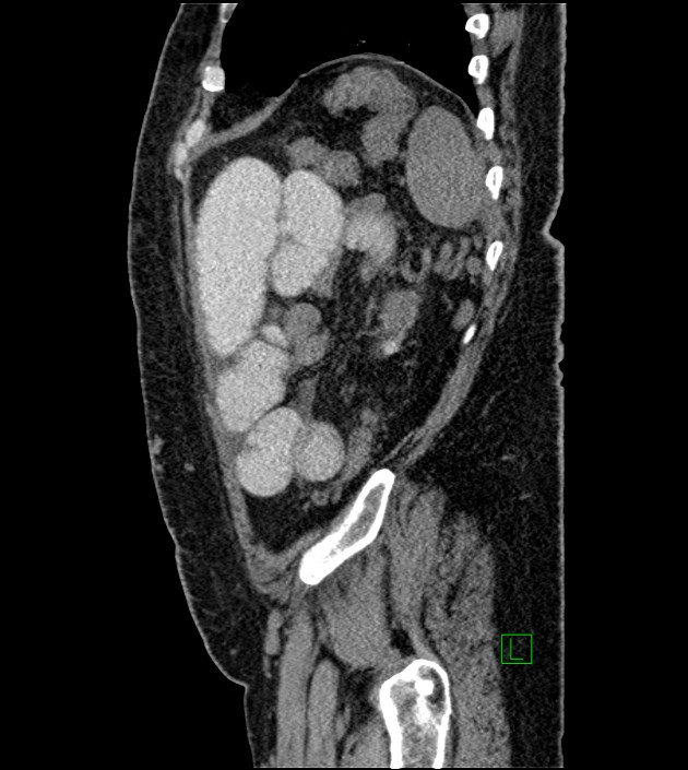 Closed-loop small bowel obstruction-internal hernia (Radiopaedia 78439-91096 C 35).jpg