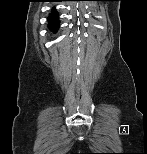 Closed loop obstruction - internal hernia into nephrectomy bed (Radiopaedia 59867-67320 B 130).jpg