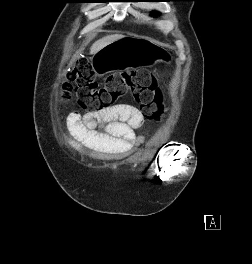 File:Closed loop obstruction - internal hernia into nephrectomy bed (Radiopaedia 59867-67320 B 9).jpg