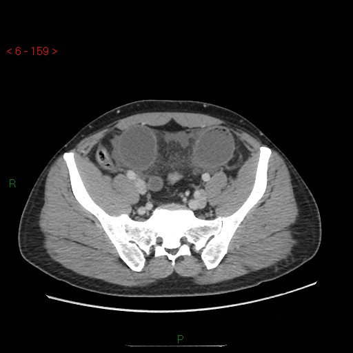 Closed loop obstruction and appendicular stump mucocele (Radiopaedia 54014-60163 A 94).jpg