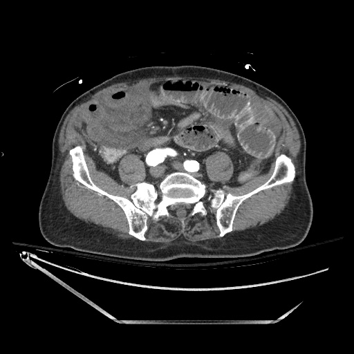 Closed loop obstruction due to adhesive band, resulting in small bowel ischemia and resection (Radiopaedia 83835-99023 B 105).jpg