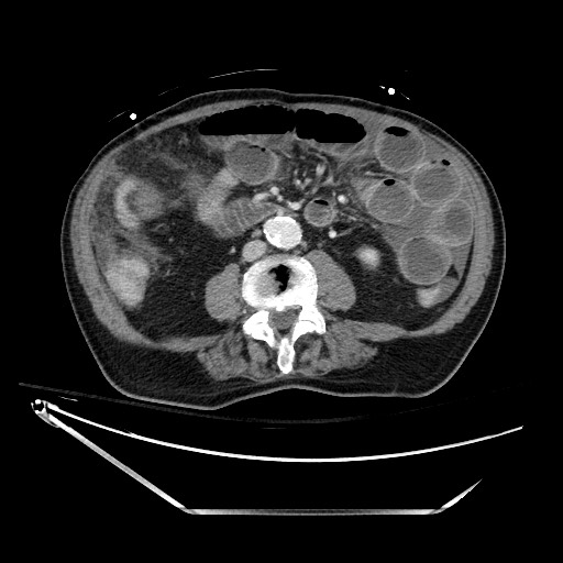 Closed loop obstruction due to adhesive band, resulting in small bowel ischemia and resection (Radiopaedia 83835-99023 D 84).jpg
