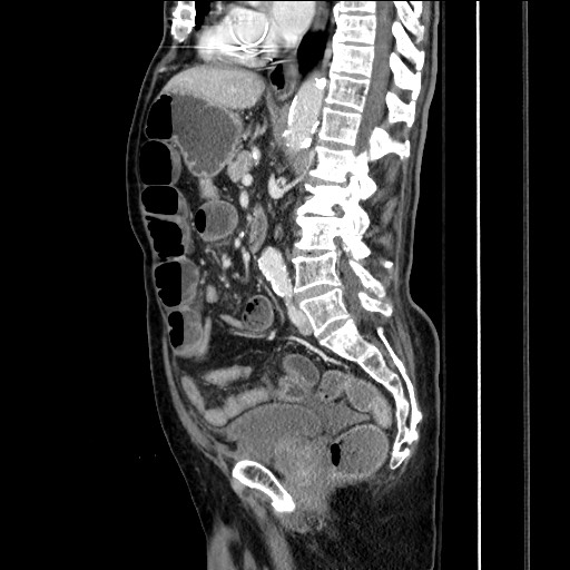 File:Closed loop obstruction due to adhesive band, resulting in small bowel ischemia and resection (Radiopaedia 83835-99023 F 102).jpg