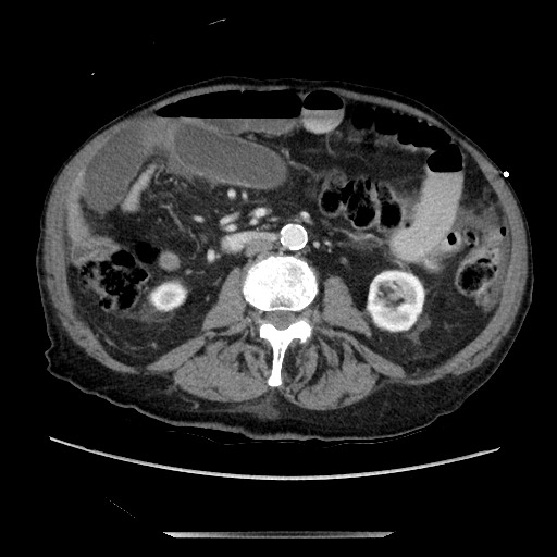 File:Closed loop small bowel obstruction - adhesive disease and hemorrhagic ischemia (Radiopaedia 86831-102990 A 97).jpg