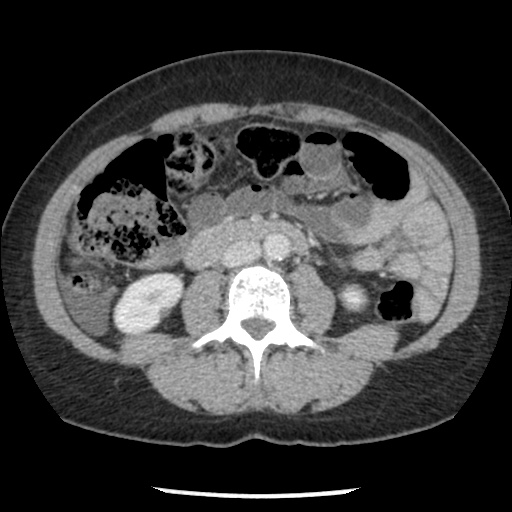 File:Closed loop small bowel obstruction due to trans-omental herniation (Radiopaedia 35593-37109 A 45).jpg