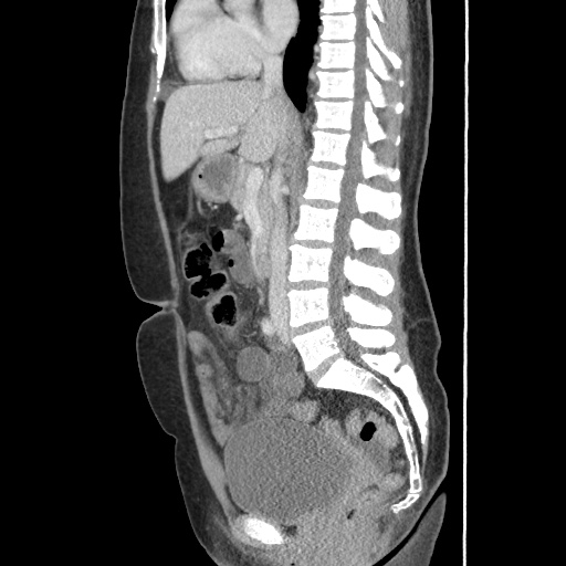 File:Closed loop small bowel obstruction due to trans-omental herniation (Radiopaedia 35593-37109 C 33).jpg