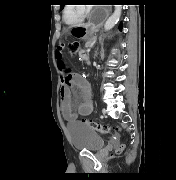 Closed loop small bowel obstruction with ischemia (Radiopaedia 84180-99456 C 55).jpg