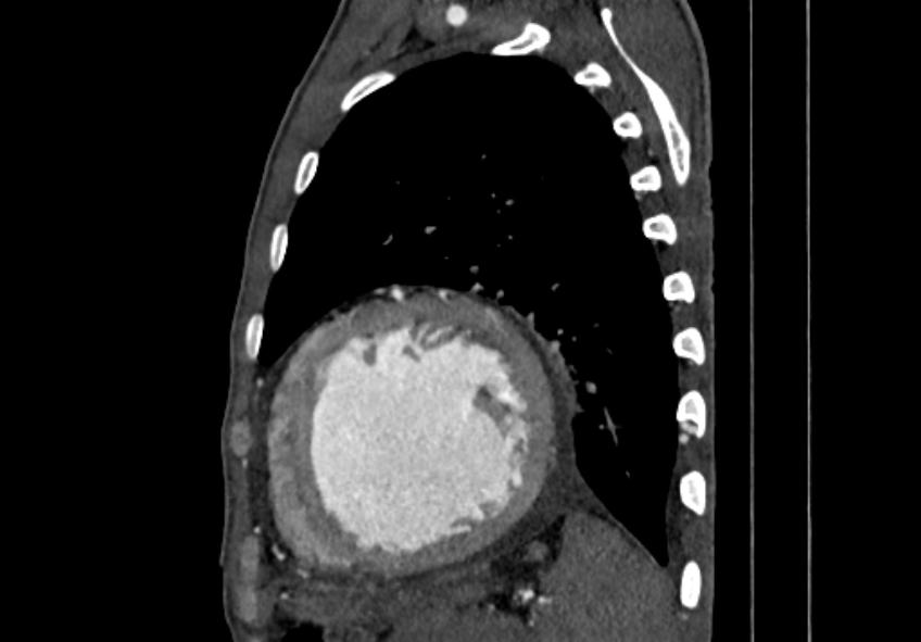 Coarctation of aorta with aortic valve stenosis (Radiopaedia 70463-80574 B 169).jpg