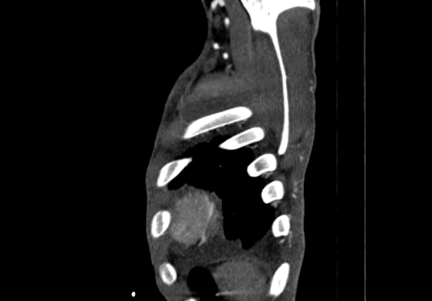 Coarctation of aorta with aortic valve stenosis (Radiopaedia 70463-80574 B 232).jpg