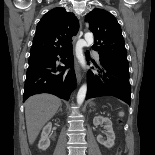 File:Coarctation of the aorta (Radiopaedia 17427-17116 A 37).jpg