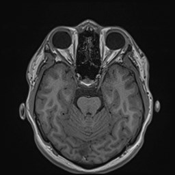 File:Cochlear incomplete partition type III associated with hypothalamic hamartoma (Radiopaedia 88756-105498 Axial T1 78).jpg