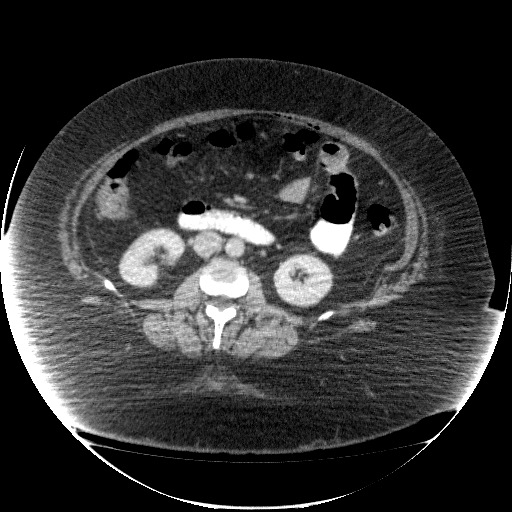 Collection due to leak after sleeve gastrectomy (Radiopaedia 55504-61972 A 40).jpg