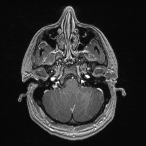 File:Colloid cyst (Radiopaedia 44510-48181 Axial T1 C+ 45).png
