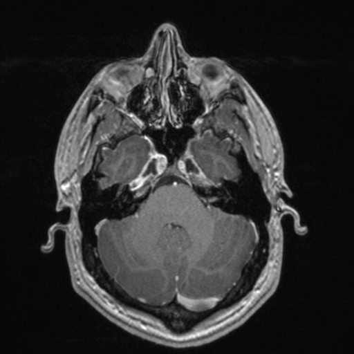File:Colloid cyst (Radiopaedia 44510-48181 Axial T1 C+ 55).png