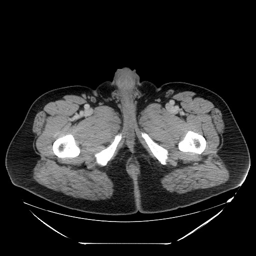 File:Colocolic intussusception due to lipoma (Radiopaedia 73712-84508 Axial 128).jpg