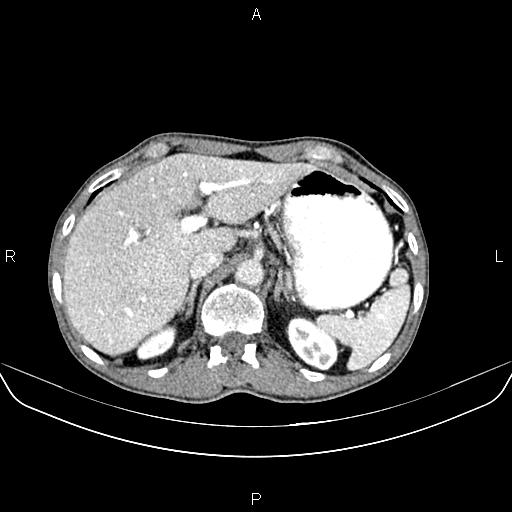 Colon adenocarcinoma - hepatic flexure (Radiopaedia 85635-101395 A 22).jpg