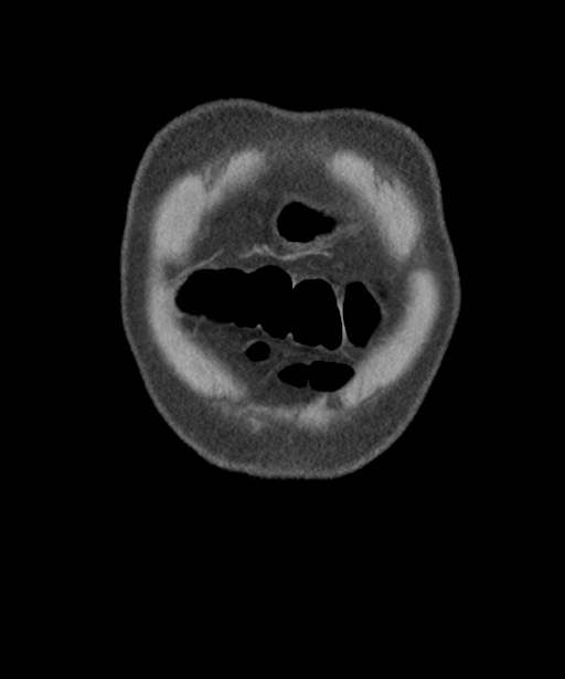 Colon adenocarcinoma - splenic flexure (Radiopaedia 34143-35406 B 8).png