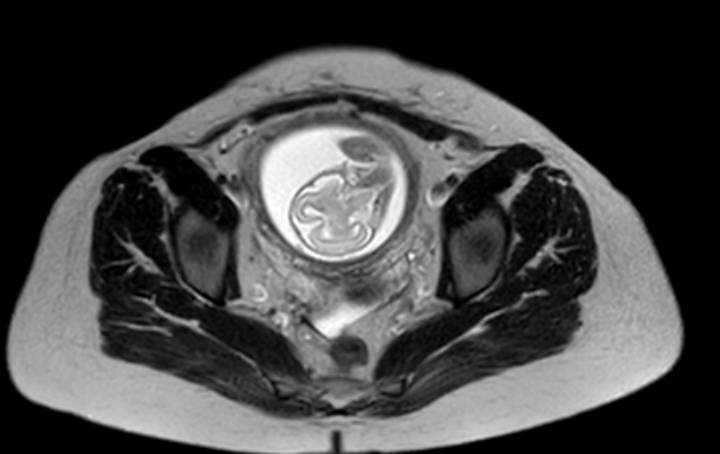 Colon adenocarcinoma with Krukenberg tumors, advanced pregnancy (Radiopaedia 67279-76645 Axial T2 13).jpg