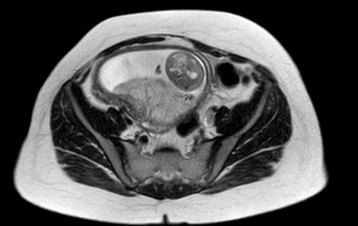File:Colon adenocarcinoma with Krukenberg tumors, advanced pregnancy (Radiopaedia 67279-76645 Axial T2 21).jpg